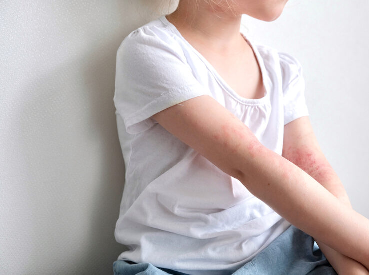 The Challenges of Having Eczema in Summer