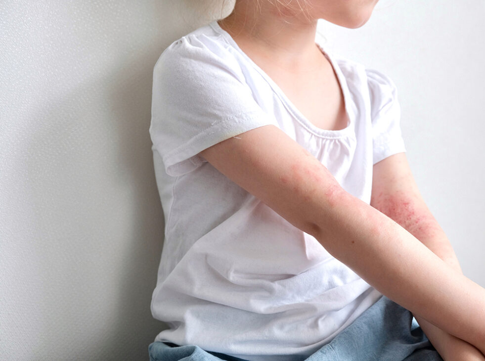 The Challenges of Having Eczema in Summer